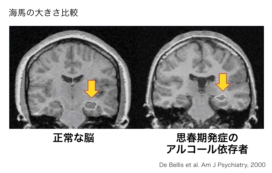 記憶力が低下するの図